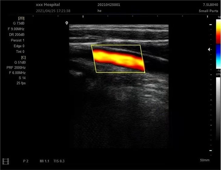 3D Color Doppler Ultrasound Scanner With Convex Probe