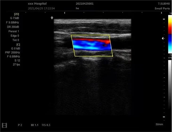 3D Color Doppler Ultrasound Scanner With Convex Probe
