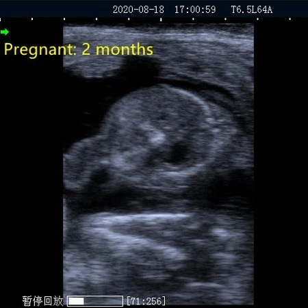 iamge of ultrasound iamge of ultrasound